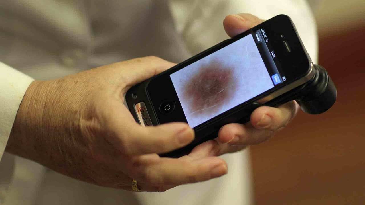 Una app usa la inteligencia artificial para detectar cáncer de piel